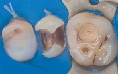 Premolar prepared and ready for the dental matrix to be placed The old filling has been removed and the premolar is prepared for the placement of the dental matrix.