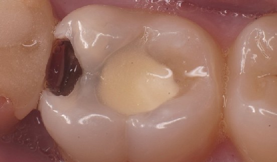 Molar viewed from above and ready for preparation View of the molar with cavity prior to preparation from above.