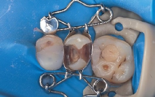 The dental matrix fits perfectly on the premolar and automatically forms a beautiful shape for the filling. The dental matrix fits perfectly on the premolar, automatically forming a beautiful shape for the filling and immediately sealing the cervical area.