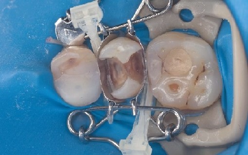 The dental mould fits perfectly on the premolar and automatically forms a beautiful shape for the composite filling to be inserted.